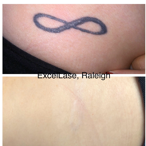 Explore space filler tattoo ideas, creative tattoo ideas in Raleigh, available at ExcelLase