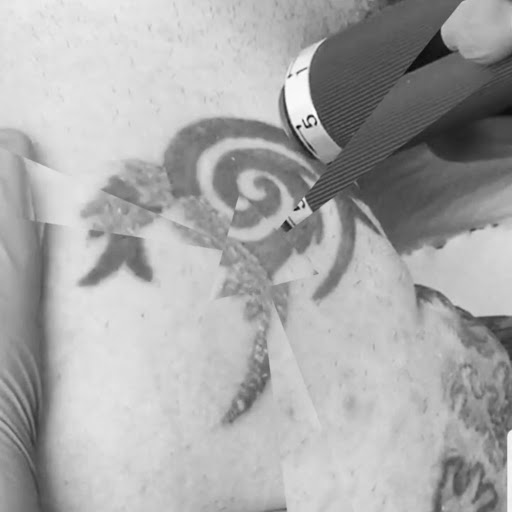 Miki Tattoo Killer | Eliminación láser de tatuajes