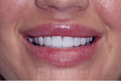 Teeth whitening service Burbank