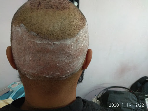 Dr Vivek Galani's RQC Hair Transplant & Skin Clinic - 211,212 Deepkamal 2  Doctor House, near Varachha Main Road, Sarthana Jakat Naka - Kamrej Rd,  Surat, Gujarat, IN - Zaubee