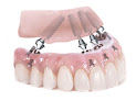 Implante Dental Santiago Centro