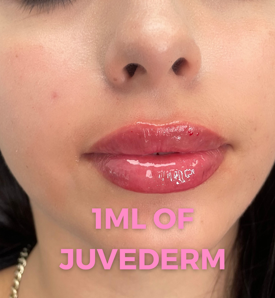Lip augmentation lip injections in Beverly Ridge Estates thumbnail