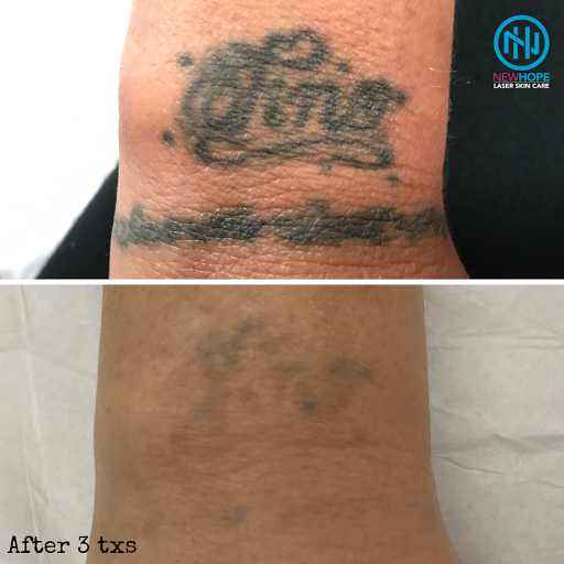 Explore lion sleeve tattoo ideas, creative tattoo ideas in Westminster, available at Newhope Laser Skin Care