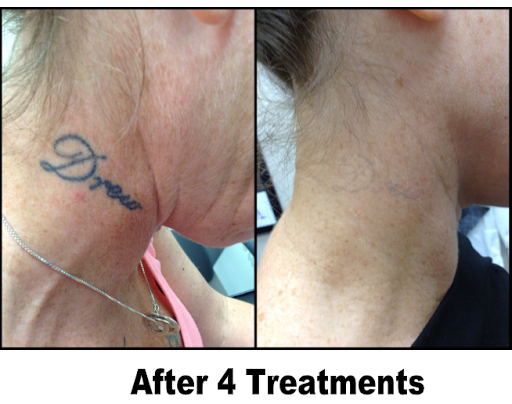 Explore tattoo ideas for deceased mother, creative tattoo ideas in King Of Prussia, available at Inkaway Laser Tattoo Removal