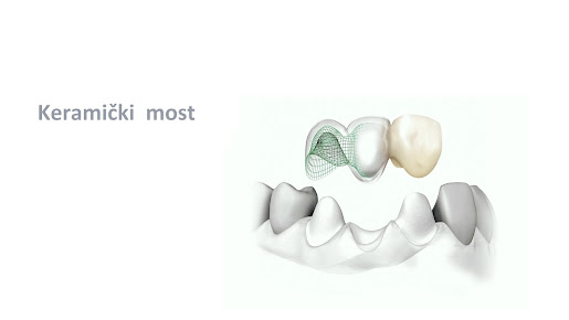 Dental Implant Clinic Krhen - Dental Implant Clinic Krhen
