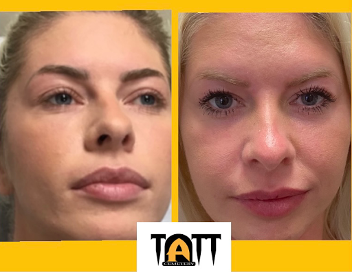 Explore campfire tattoo ideas, creative tattoo ideas in Fort Myers, available at Laser Tattoo Removal by Tatt Cemetery