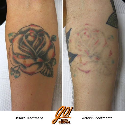 Explore kakashi tattoo ideas, creative tattoo ideas in Allentown, available at Removery Tattoo Removal & Fading