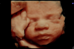 Peek-A-View Baby 3D/4D Elective Ultrasound image
