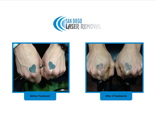 Explore cheshire cat tattoo ideas, creative tattoo ideas in San Diego, available at Removery Tattoo Removal & Fading