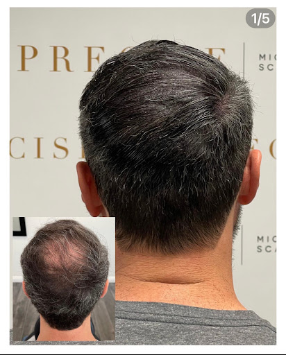 Precise Scalp Micro - Scalp Micropigmentation Service and Training image