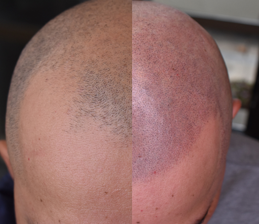 The Scalp Barber Scalp Micropigmentation Hair Loss Solution By Allure