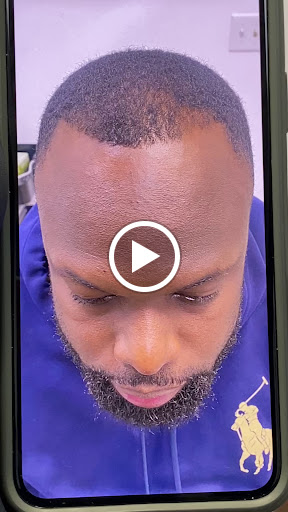 Precise Scalp Micro - Scalp Micropigmentation Service and Training image