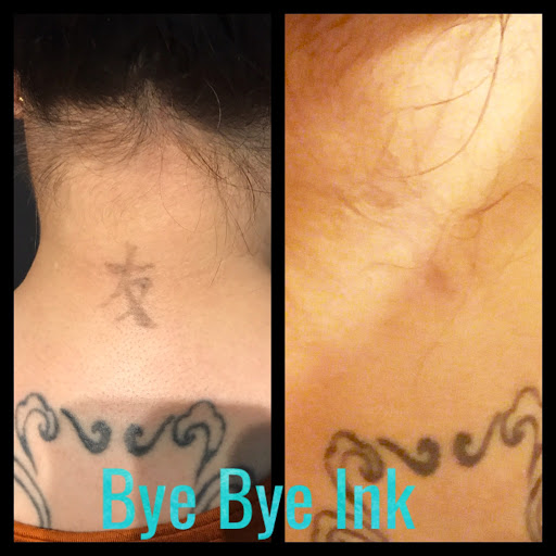 Explore cherry tattoo ideas, creative tattoo ideas in Middle Village, available at Bye Bye Ink Laser Tattoo Removal