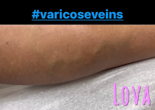 Explore westside tattoo ideas, creative tattoo ideas in Lake Oswego, available at Lake Oswego Vein and Aesthetic LOVA