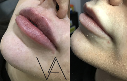 V&A Aesthetics - London Lip Fillers, Chin, Nose, Cheek & Jaw Filler Clinic - London