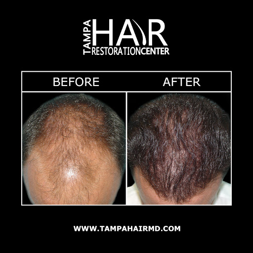 Hair Replacement Service «Tampa Hair Restoration Center», reviews and photos, 6730 W Linebaugh Ave #101a, Tampa, FL 33625, USA
