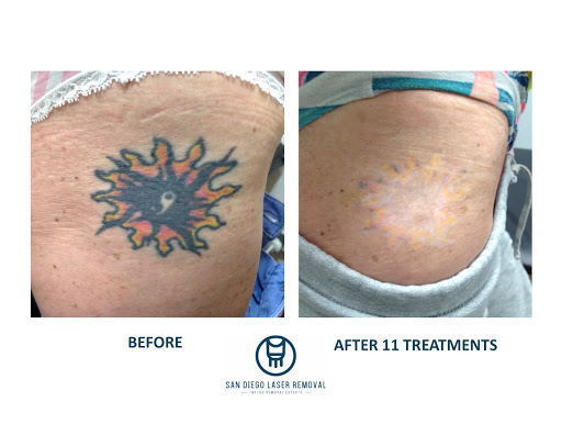 Explore hydrangea tattoo ideas, creative tattoo ideas in San Diego, available at Removery Tattoo Removal & Fading