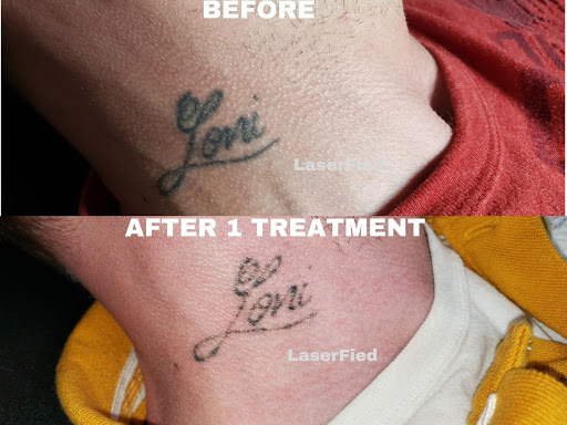 Laserfied Laser Tattoo Removal Milwaukee, WI