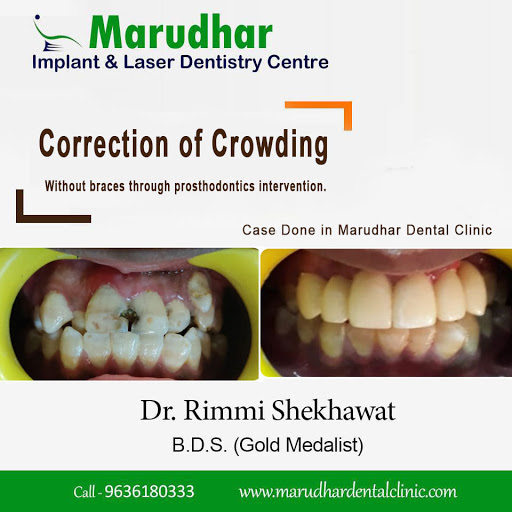 Best Dentist Jaipur - Marudhar Dental Clinic, Dental Clinic, Dental Implant, Dental Treatment