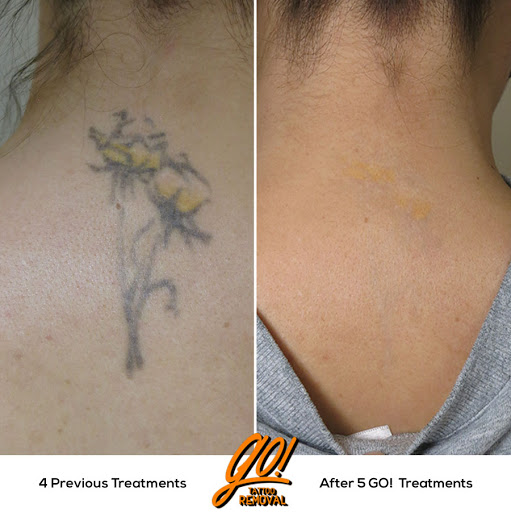 Explore dragonfly flower tattoo ideas, creative tattoo ideas in Allentown, available at Removery Tattoo Removal & Fading