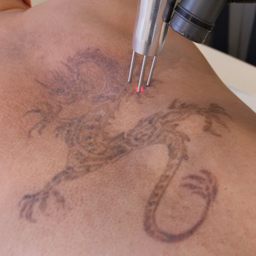Explore pennywise tattoo ideas, creative tattoo ideas in San Diego, available at Evolve Tattoo Removal