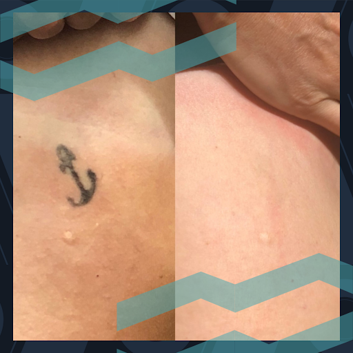 Explore mars attacks tattoo ideas, creative tattoo ideas in Houston, available at Removery Tattoo Removal & Fading