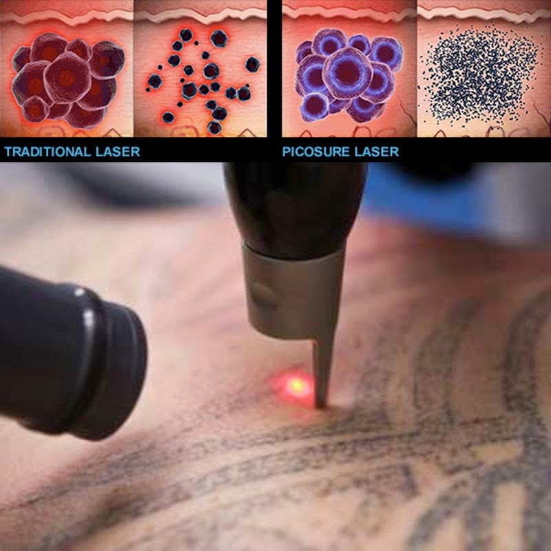 "Fleur de Lis" - Laser Tattooentfernung PicoSure - mit Power Boost !