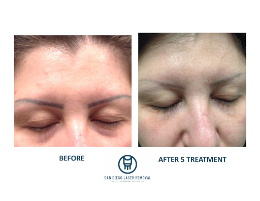 Explore jolly roger tattoo ideas, creative tattoo ideas in San Diego, available at Removery Tattoo Removal & Fading