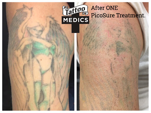 Find unique best friend tattoo ideas for your next unique tattoo in Providence at TattooMedics Laser Tattoo Removal
