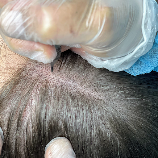 Scalp Micro Portugal- Micropigmentação Capilar Porto