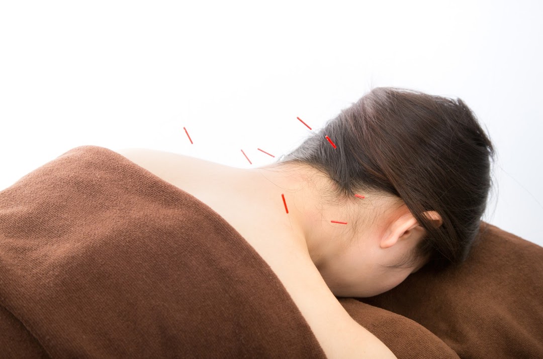 Shizue Hayashi Ito Acupuncture (BEST Chiropractic Costa Mesa)