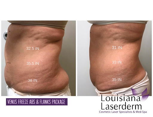 Explore tattoo cover up ideas for guys, creative tattoo ideas in Baton Rouge, available at Louisiana Laserderm