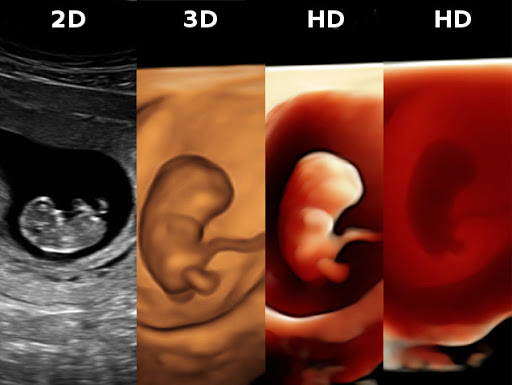 Meet the Baby Ultrasound