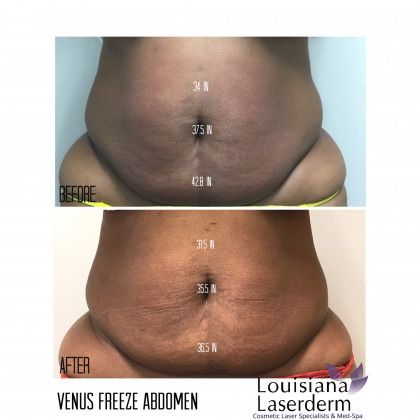 Explore black and gray tattoo ideas, creative tattoo ideas in Baton Rouge, available at Louisiana Laserderm