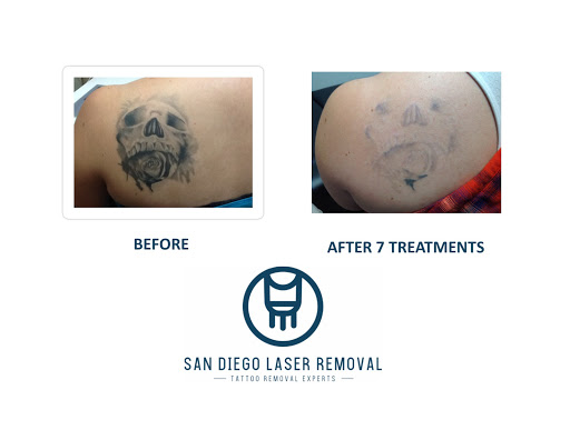 San Diego Laser Tattoo Removal