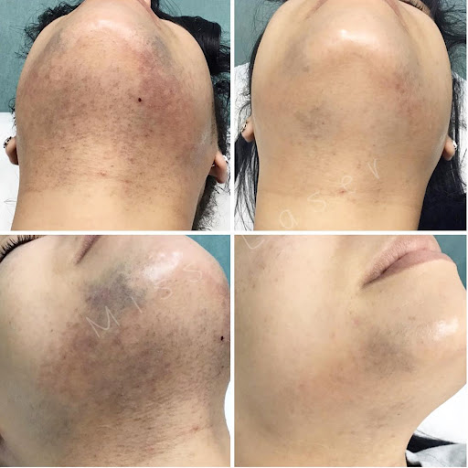 Explore fall leaf tattoo ideas, creative tattoo ideas in Jackson Heights, available at Miss Laser - Laser Hair Removal, Tattoo Removal & Body Contouring