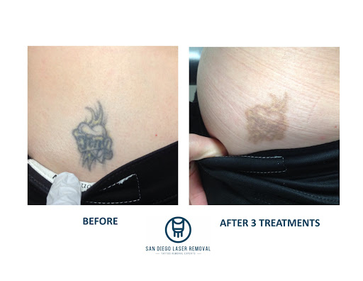 Explore bandana tattoo ideas, creative tattoo ideas in San Diego, available at Removery Tattoo Removal & Fading