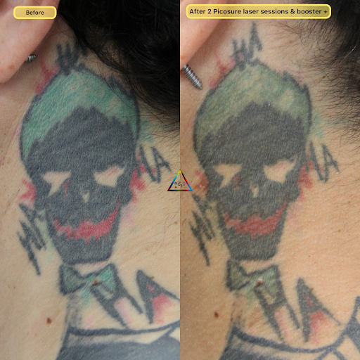 Explore risk taker tattoo ideas, creative tattoo ideas in New York, available at Ag2g Laser Tattoo Removal & MedSpa