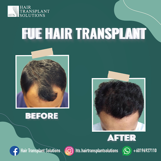 Hair Transplant Solutions