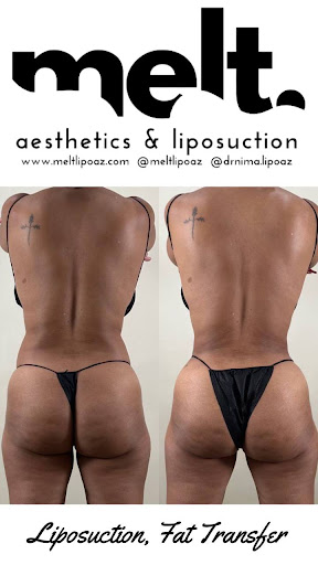 Melt Aesthetics and Liposuction Arizona fat transfer