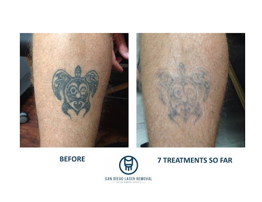 Explore abuse survivor tattoo ideas, creative tattoo ideas in San Diego, available at Removery Tattoo Removal & Fading