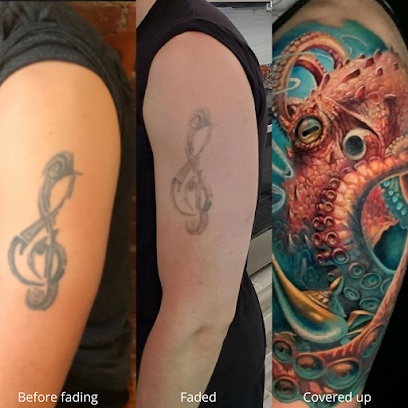 Removery Tattoo Removal & Fading