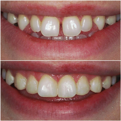 Teeth whitening in Leeds