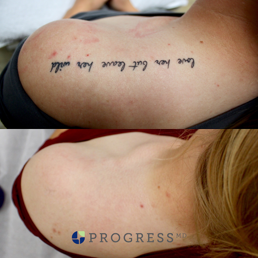Explore dc comic tattoo ideas, creative tattoo ideas in Amarillo, available at Progress MD Tattoo Removal