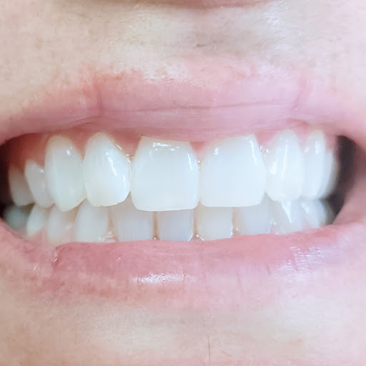 Arizona Teeth Whitening