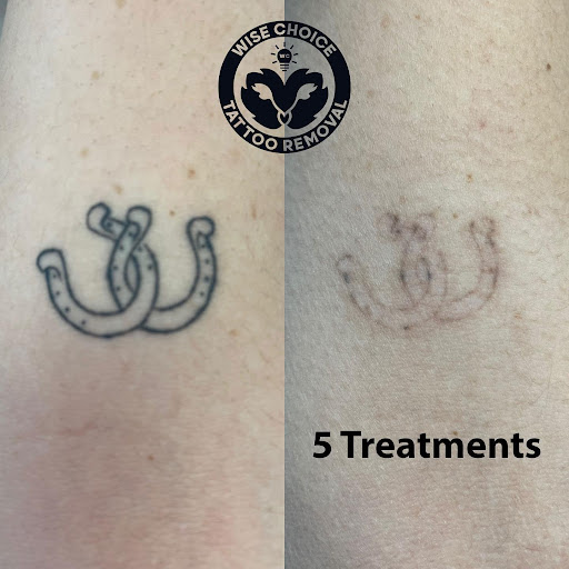 Explore overcoming tattoo ideas, creative tattoo ideas in Denver, available at Wise Choice Tattoo Removal