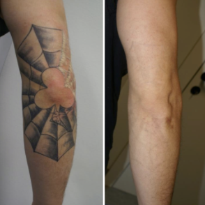 Explore inner arm cover up tattoo ideas, creative tattoo ideas in Portland, available at Oregon Medical & Laser (formerly Cascade Medical & Tattoo Removal)
