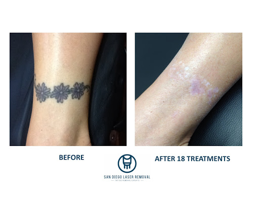 Explore tattoo ideas for diabetes, creative tattoo ideas in San Diego, available at Removery Tattoo Removal & Fading