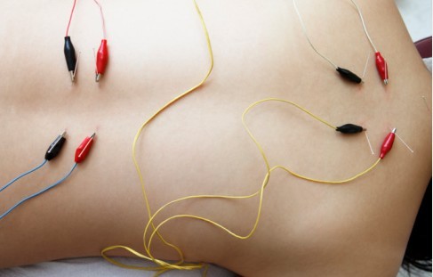 AMP Acupuncture & Medical Practice - Electroacupuncture, Affordable Acupuncture and Cupping Clinic