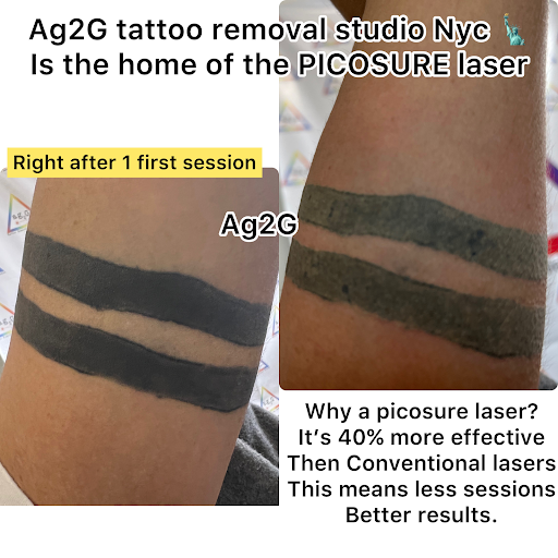 Explore knuckle tattoo cover up ideas, creative tattoo ideas in New York, available at Ag2g Laser Tattoo Removal & MedSpa